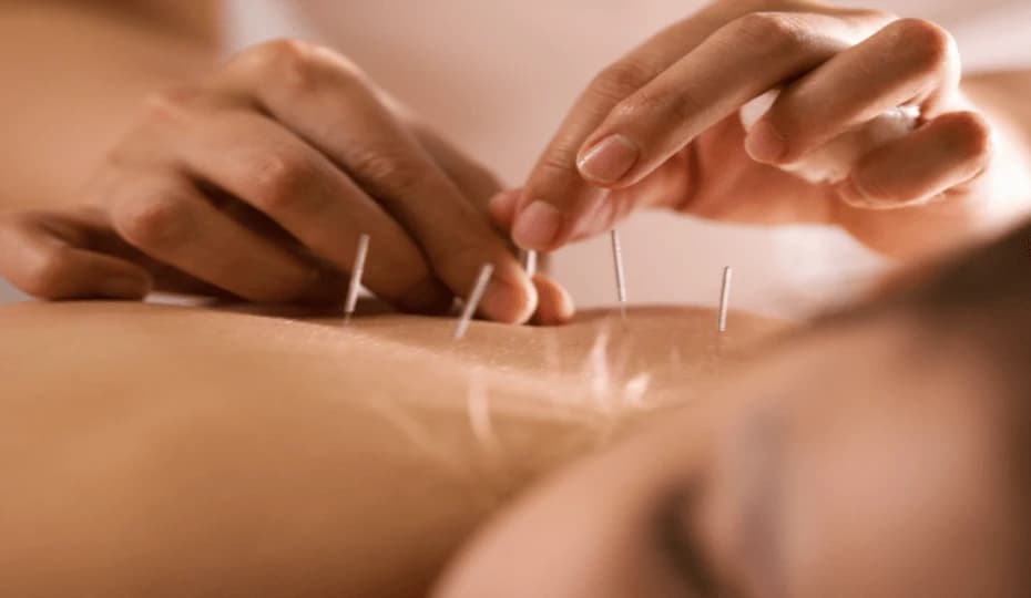 Acupuncture