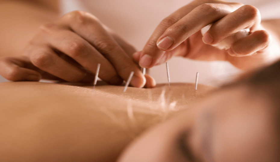 acupuncture therapy